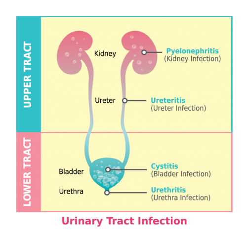 Understanding UTI | UTIPure |The Trusted Urinary Alkalinizer for Women ...